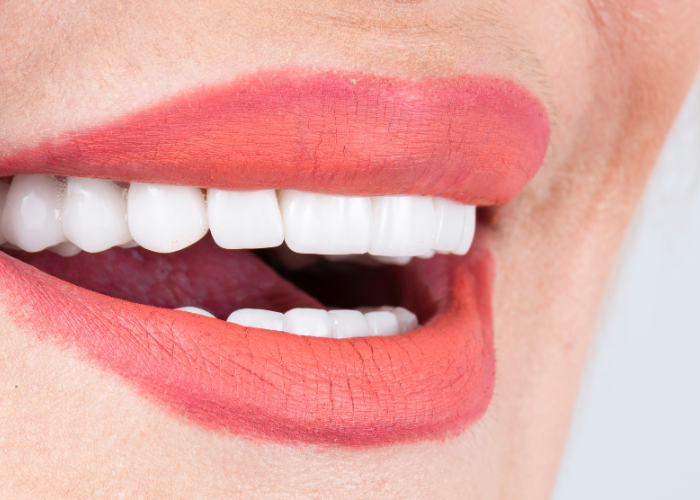 Bọc răng sứ có hết hô không? Quy trình thực hiện ra sao