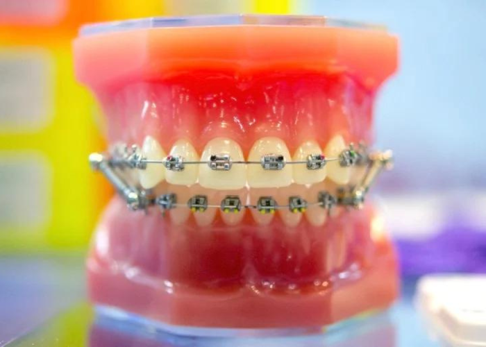 Bọc răng sứ có niềng được không? Giải đáp