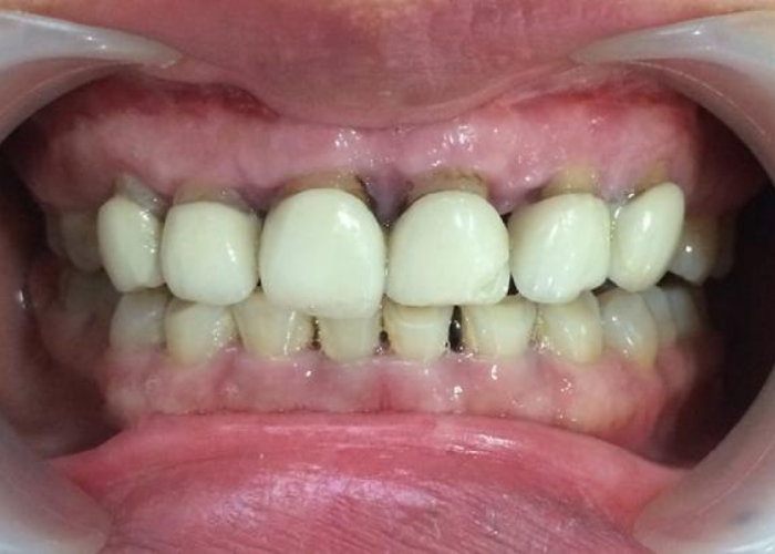 Những nguy cơ tiềm ẩn của bọc răng sứ giá rẻ