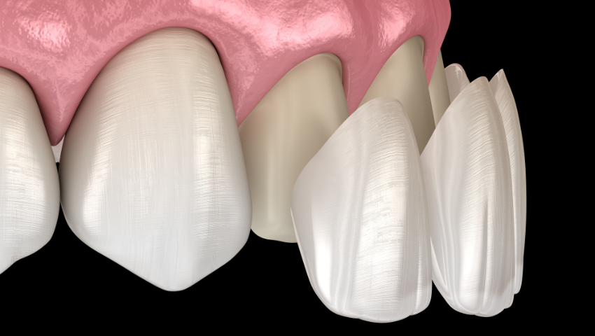 boc-rang-su-khong-mai-1