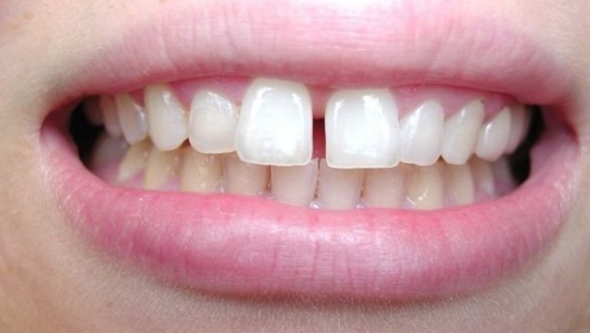 boc-rang-su-khong-mai-2