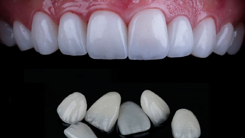 boc-rang-su-khong-mai-3