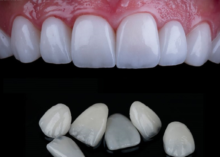 Tìm hiểu về phương pháp bọc răng sứ không mài