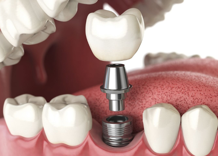 Các bước trồng răng Implant tại nha khoa Wilson