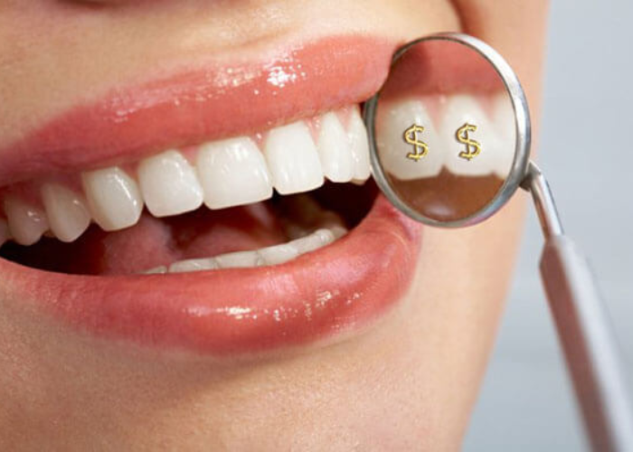 Chi phí bọc răng sứ răng cửa bao nhiêu tiền 1 chiếc