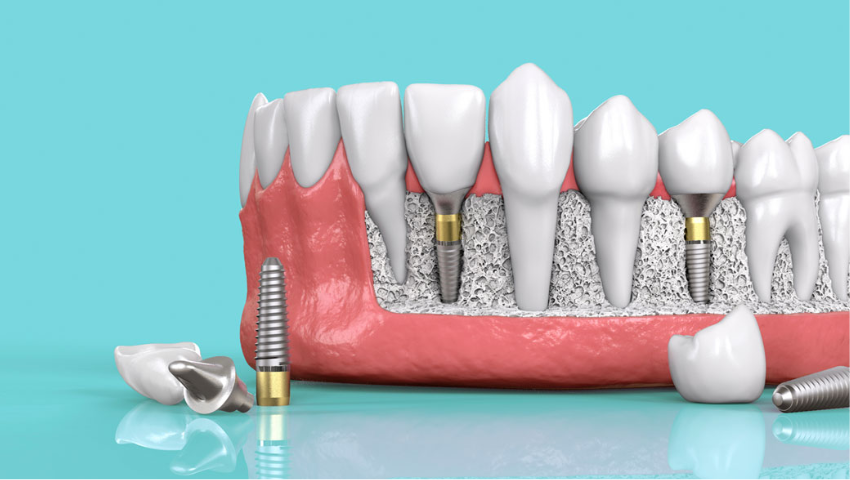 Có nên trồng răng Implant để phục hình răng đã mất?