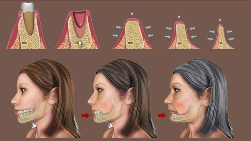 co-nen-trong-rang-implant-3