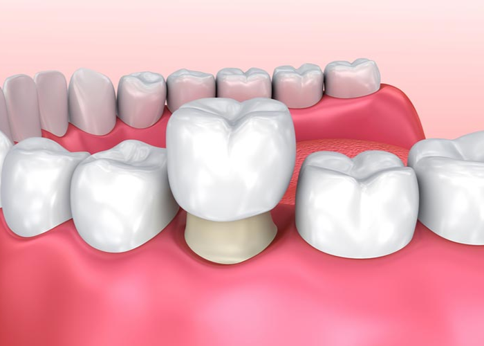 Nhược điểm của bọc răng sứ theo khuyến cáo từ chuyên gia