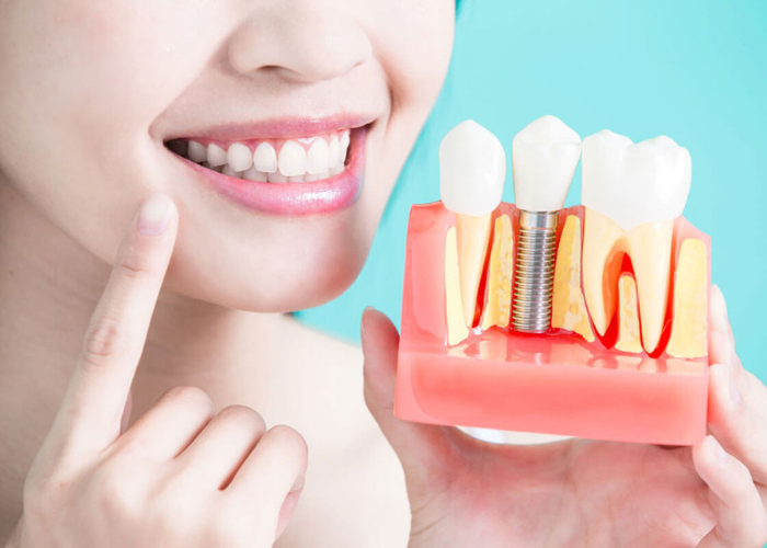 5 nhược điểm của trồng răng Implant cần phải lưu ý