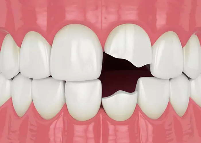 Tình trạng răng bị bể lớn có bọc sứ được không?
