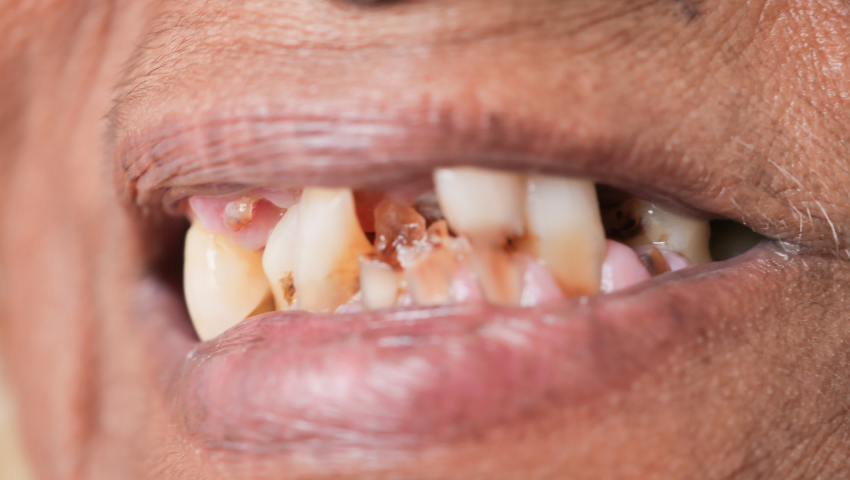 rang-sau-nang-co-boc-su-duoc-khong-1