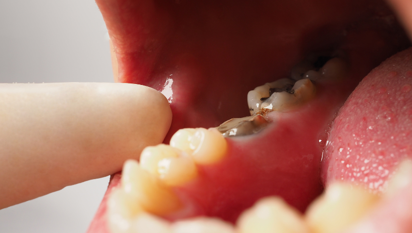 rang-sau-nang-co-boc-su-duoc-khong-2