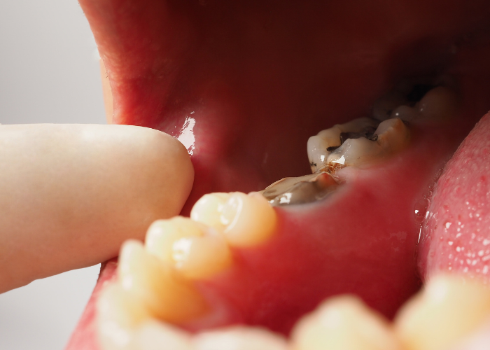 Giải đáp: Răng sâu nặng có bọc sứ được không?