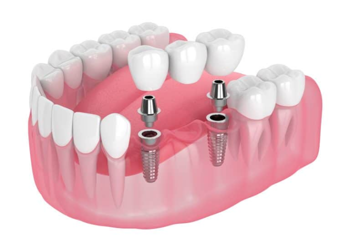 Tại sao phải trồng răng Implant?
