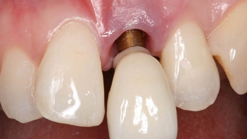 Trồng răng Implant 3 triệu – Hậu quả khôn lường khi cấy ghép Implant giá rẻ