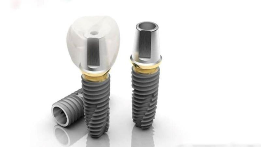 trong-rang-implant-co-may-loai-2