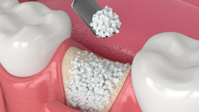 trong-rang-implant-ghep-xuong-1