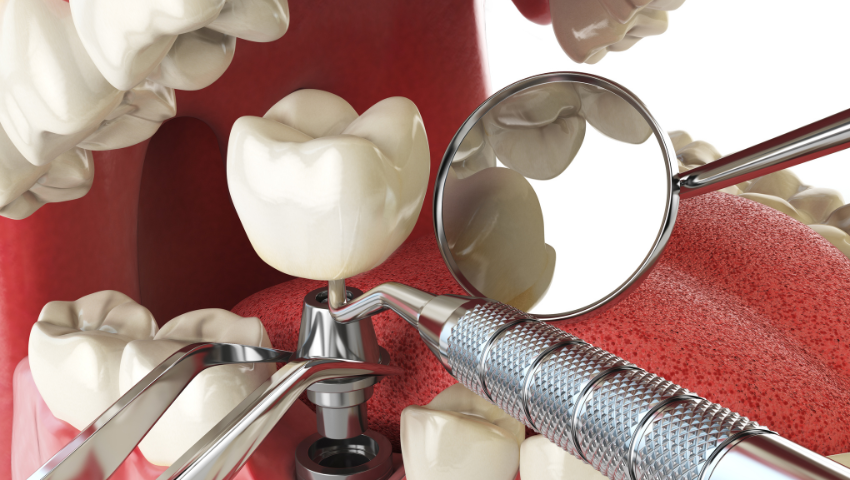 trong-rang-implant-ghep-xuong-2