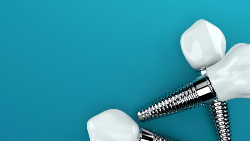 trong-rang-implant-gia-bao-nhieu-2