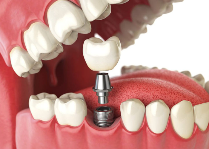 Có nên trồng răng Implant miễn phí không?