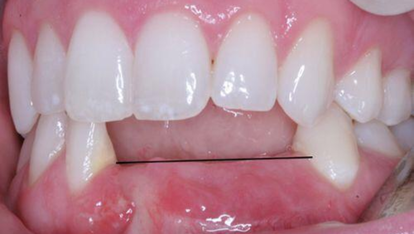 trong-rang-implant-ham-duoi-1