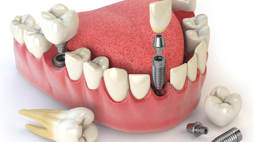 trong-rang-implant-ham-duoi-2