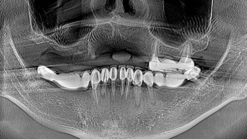 trong-rang-implant-khi-bi-tieu-xuong-1