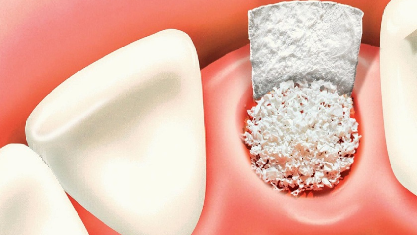 trong-rang-implant-khi-bi-tieu-xuong-2