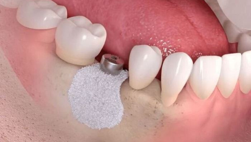 trong-rang-implant-khi-bi-tieu-xuong-3