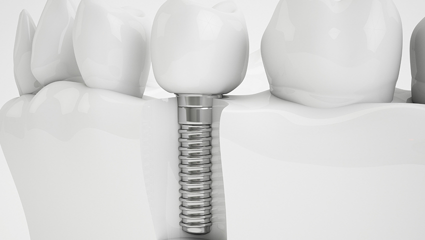 trong-rang-implant-nen-an-gi-1