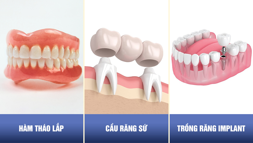 trong-rang-implant-vinh-vien-3