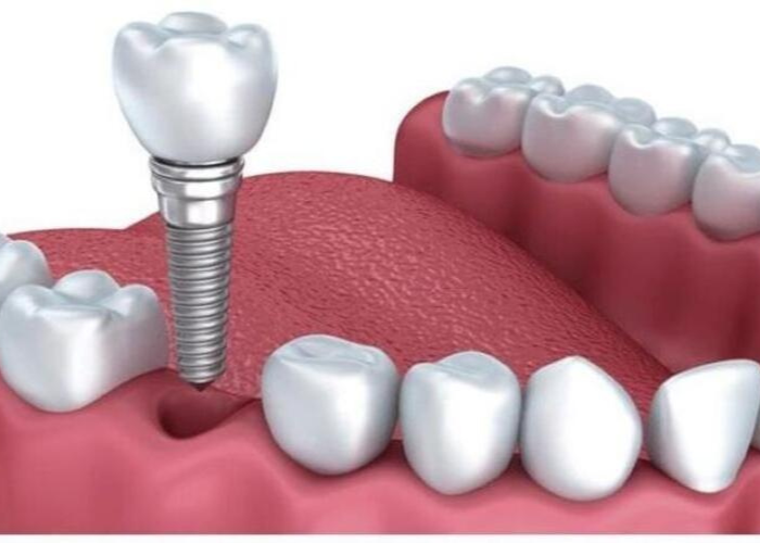 Ưu nhược điểm của trồng răng Implant
