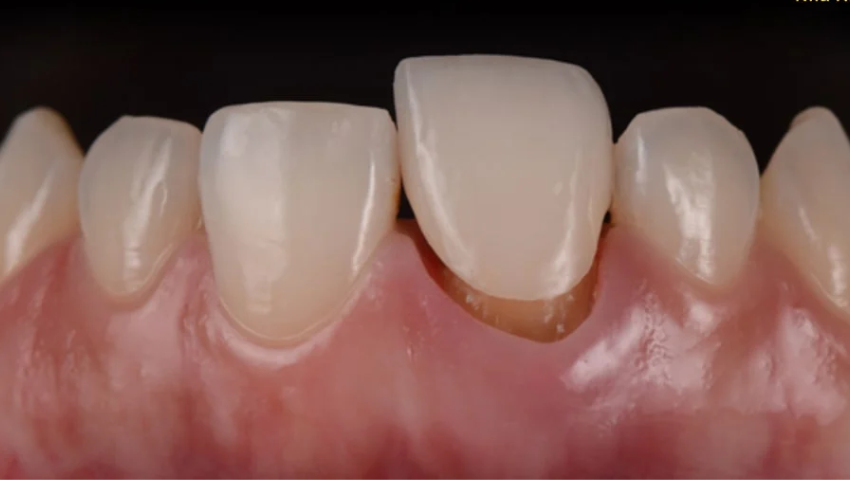 boc-rang-su-bi-tut-loi-1