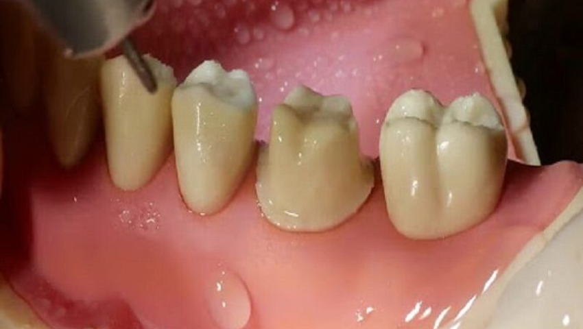 boc-rang-su-co-anh-huong-gi-khong-2