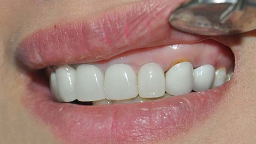 boc-rang-su-co-anh-huong-gi-khong-3