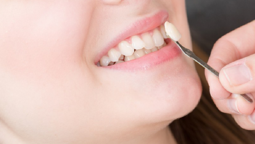 boc-rang-su-kieu-rang-tho-3