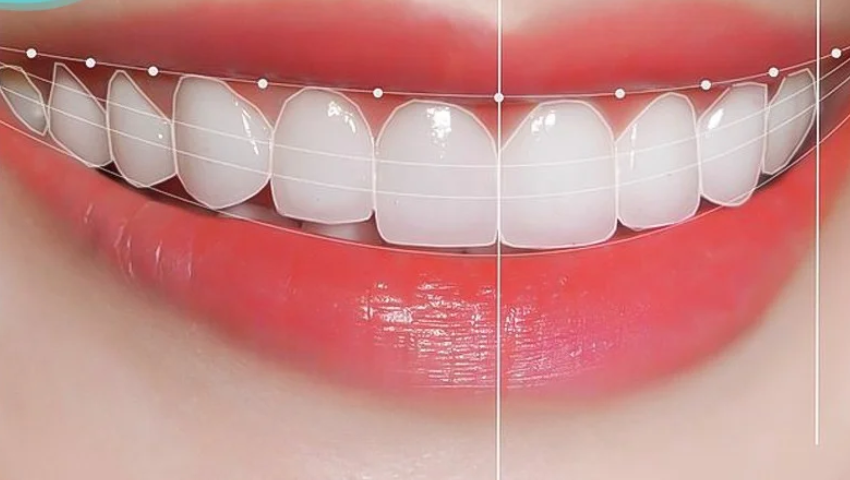 boc-rang-su-nano-5s-1