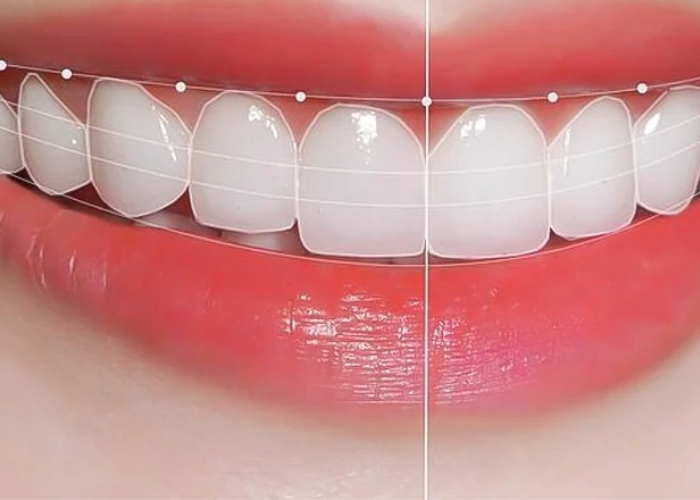 Vì sao công nghệ bọc răng sứ Nano 5S được ưa chuộng