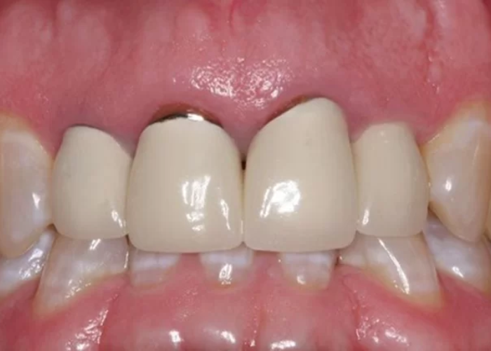 Bọc răng sứ phần chân răng bị hở do nguyên nhân nào?