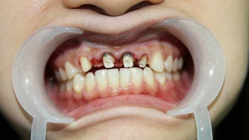 boc-rang-su-thao-ra-duoc-khong-2