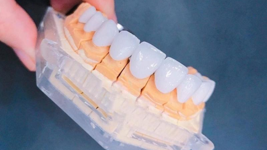 boc-rang-su-vinh-vien-gia-bao-nhieu-1