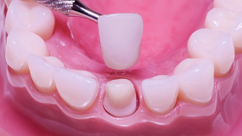 boc-rang-su-vinh-vien-gia-bao-nhieu-2