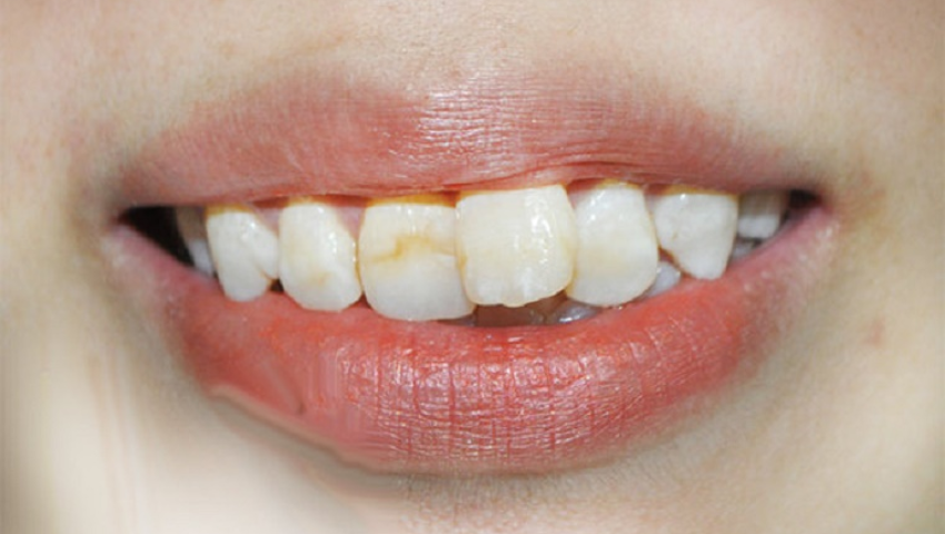 boc-su-rang-cua-bi-lech-1