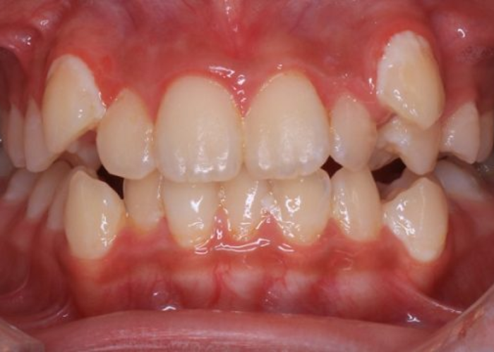 Có nên thực hiện bọc sứ răng khểnh không?