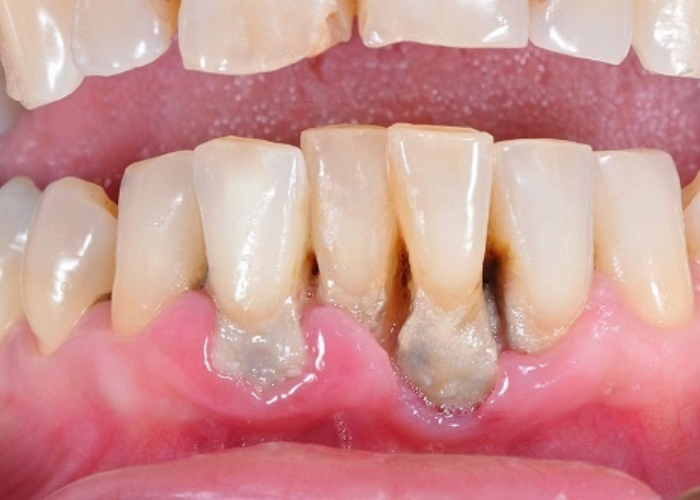 Tư vấn: Răng lung lay có bọc răng sứ được không?