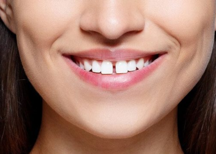 Giải đáp: Răng thưa nên niềng hay bọc răng sứ?