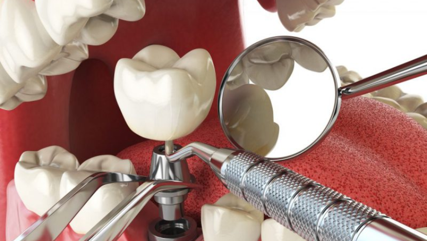 trong-rang-implant-bi-lung-lay-1