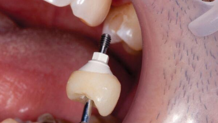 trong-rang-implant-bi-lung-lay-2