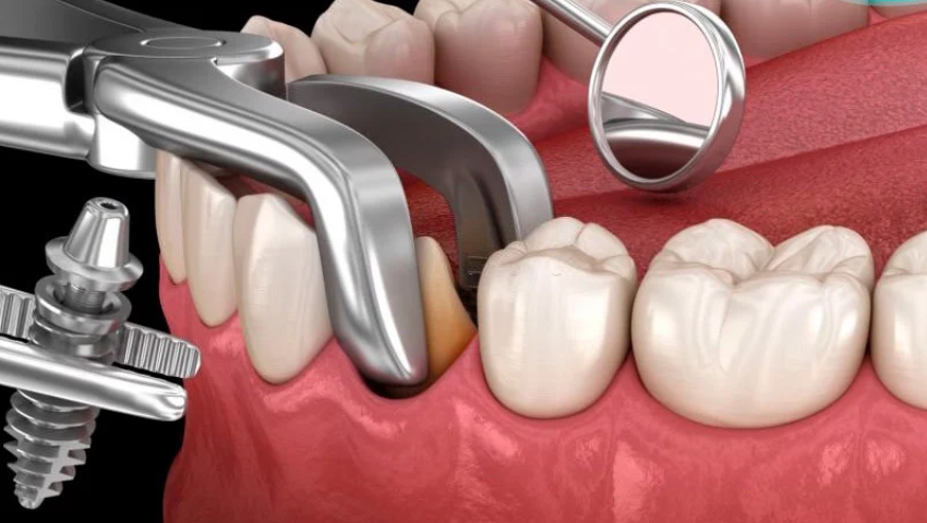 trong-rang-implant-so-7-1