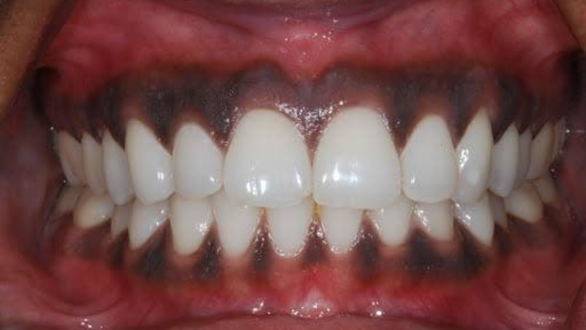 boc-rang-su-loi-bi-tham-1